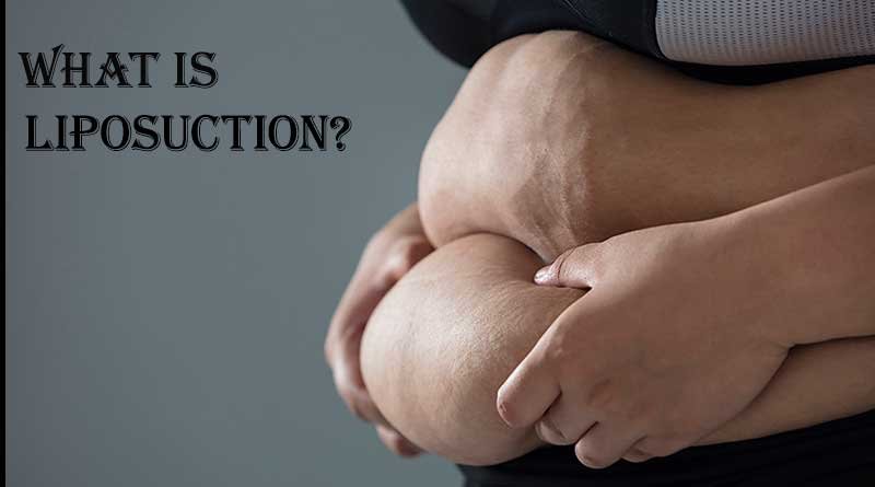 WHAT-IS-LIPOSUCTION
