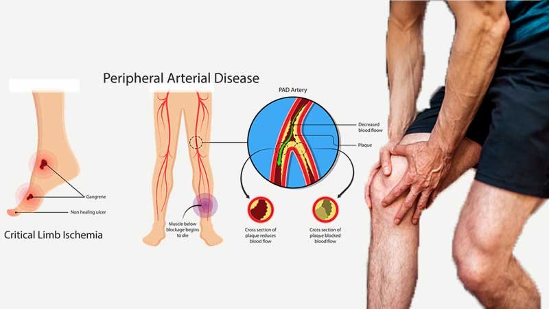 vascular-problem